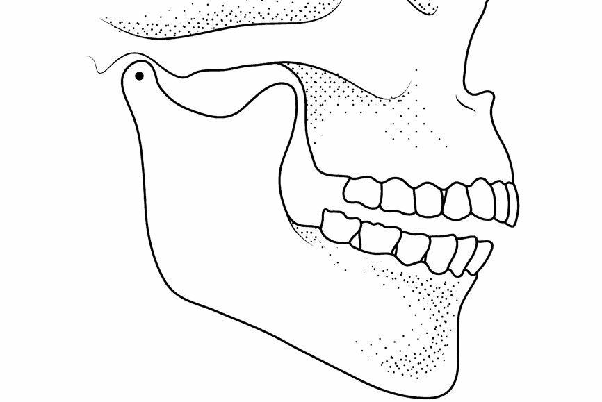 Fig. 2: Mandibular position with condyles down the eminence and maximal intercuspation.