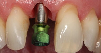 Placement of dental implants results in minimal bone loss, study shows