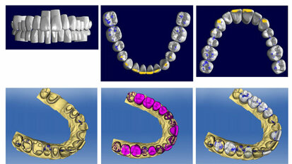 CEREC Biojaw - typical tooth restorations for the whole jaw