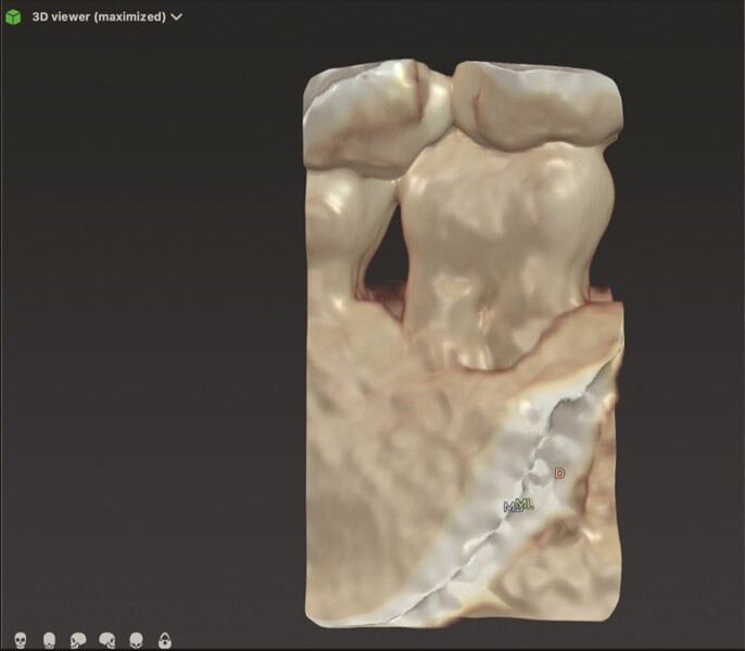 Fig. 11a : Reconstruction osseuse avec DTX Studio Clinic montrant un défaut osseux dans la région coronaire. 