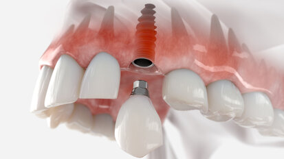 Researchers in Australia seek to improve dental implant outcomes