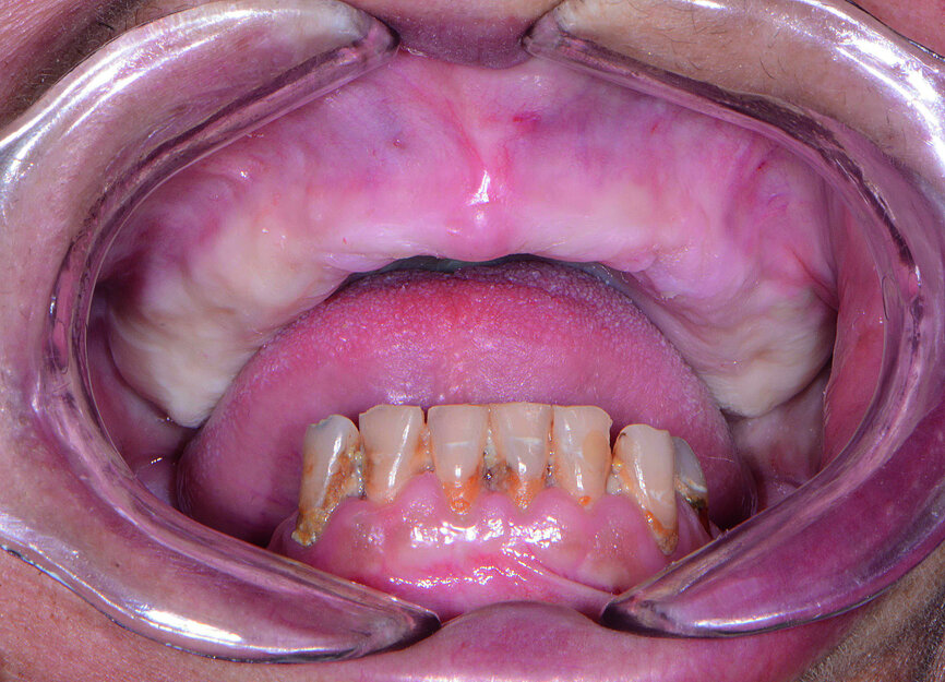 Fig. 2: Pre-op retracted view without denture.
