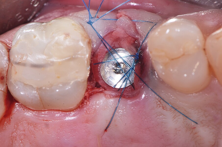 Fig. 22 : Mise en place d’une membrane de collagène et suture. 