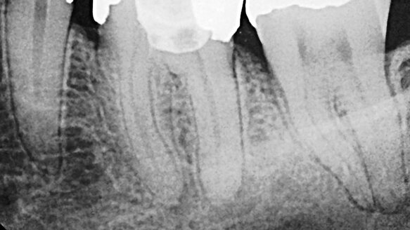 Successful single-visit molar endodontics