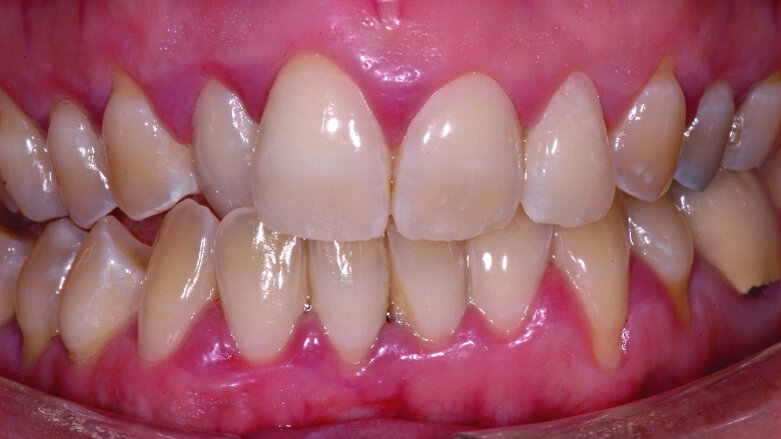 Intérêt des restaurations adhésives céramiques en dentisterie non invasive