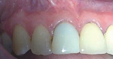 Rewizja leczenia endodontycznego po nieudanej resekcji wierzchołka korzenia