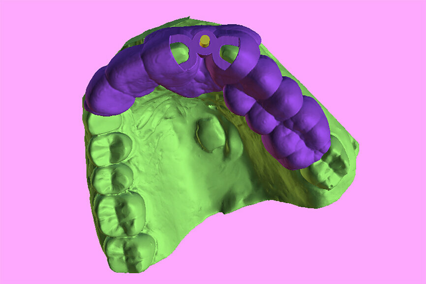 Fig. 6a: Two 3D-printed templates designed on the digitised model (green): one for the initial drill to section the tooth at the root apex (a) and the second for using sequential guided drills to drill through the root itself (b).