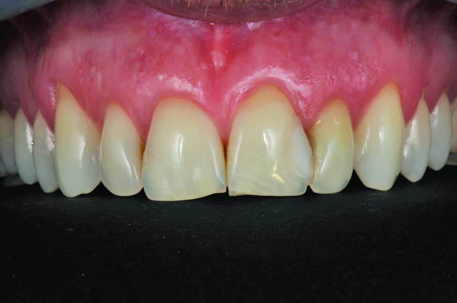 Fig. 1: Younger male patient with failing composite fillings on central well as right lateral incisors. Also in need of a crown on left lateral incisor. Agreement to make three veneers in addition to the crown to improve his aesthetics and cover the defects.