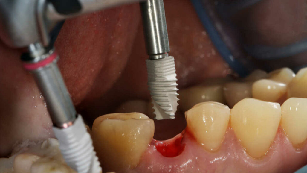 Dlouhodobá studie zkoumá rizikové faktory pro krátké zubní implantáty