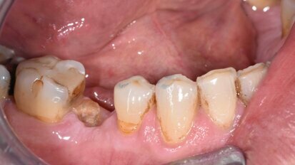 L’estrusione ortodontica: un’opportunità predicibile