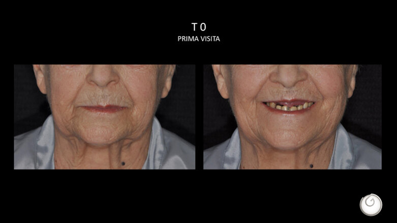 Sinergie tra odontoiatria e biorivolumetria: l’approccio terapeutico per tornare a sorriderSi