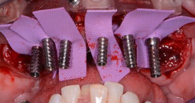 Predictable immediate guided implant placement and provisionalisation