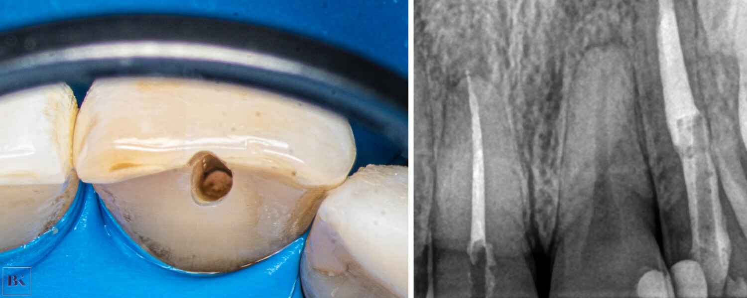 Figs. 10a & b: Obturation with gutta-percha (a) and the control radiograph (b).
