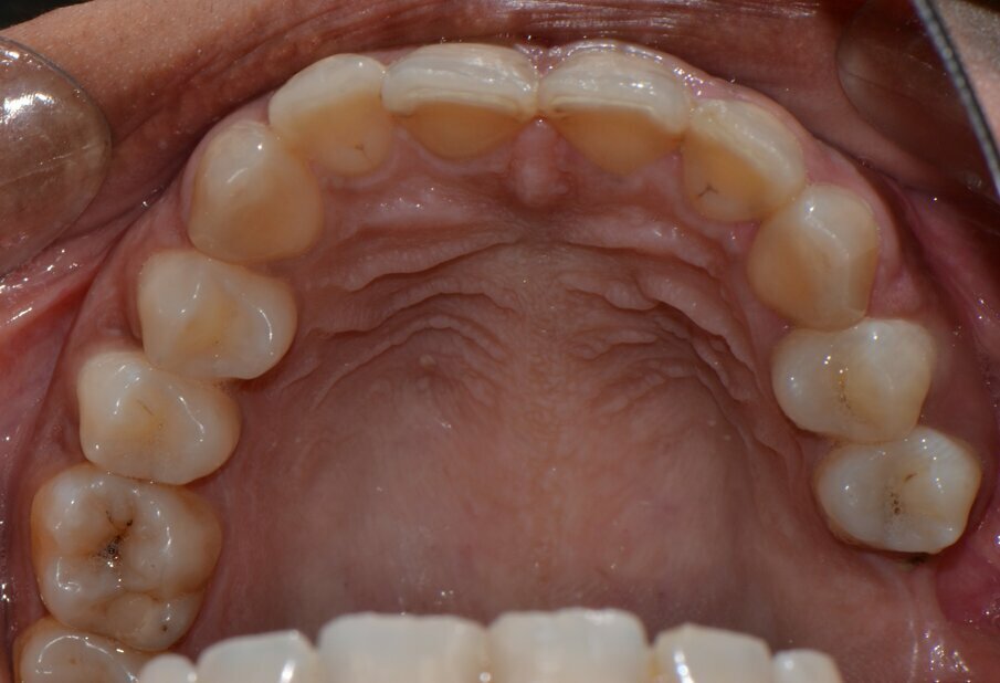 Fig 1: incisal attrition and proximal caries with upper anterior teeth