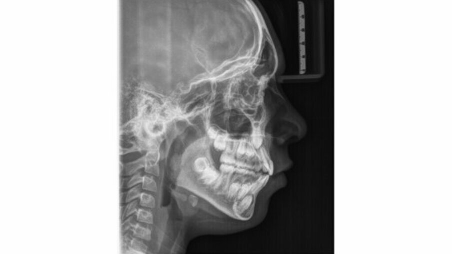 Fig. 4_Radiografia laterale del cranio.