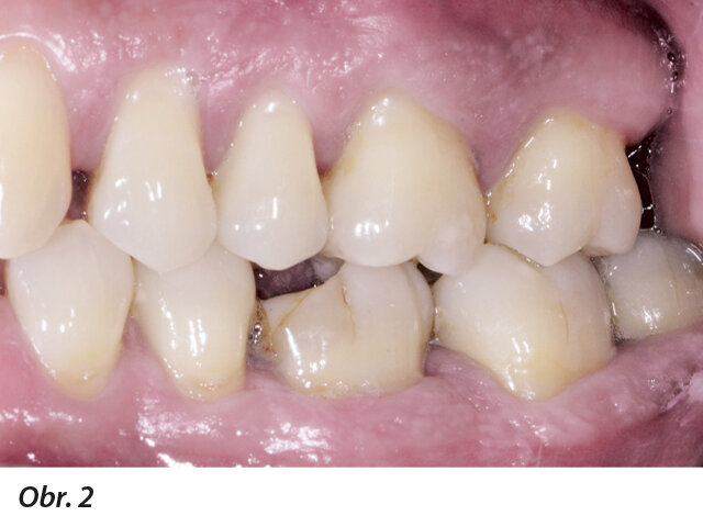 Obr. 1–5: Fotografi cká dokumentace počátečního stavu před parodontologickým ošetřením
