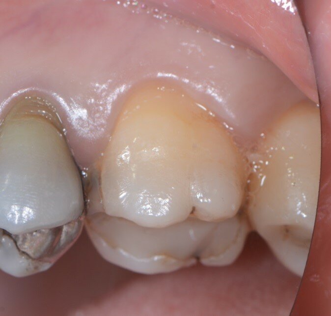 Figg. 1a, 1b - Elemento dentale n. 16 che necessita l’estrazione.