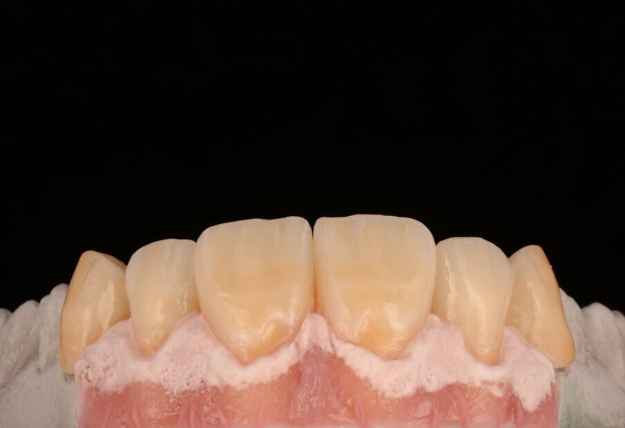 Fig. 26b: Multi-chromatic layering of gingival structures.