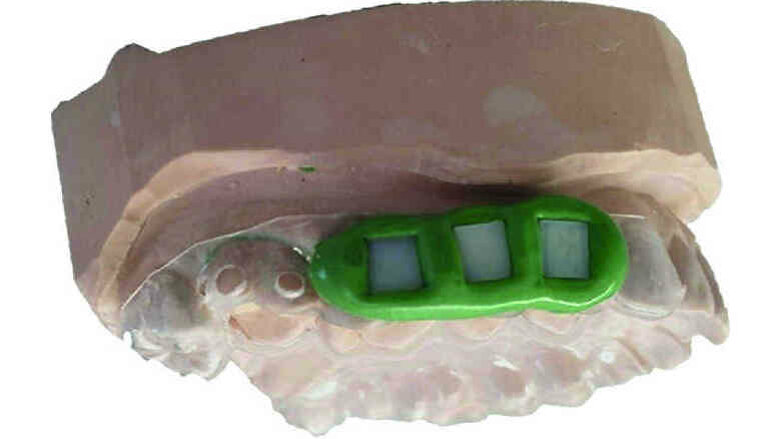 Adhésion de nanoparticules d’hydroxyapatite (HA) aux matériaux dentaires