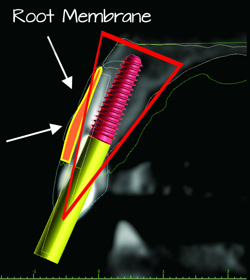 3b: The simulated implant within the Triangle of Bone (red), placed to avoid the root fragment seen in yellow (white arrows).