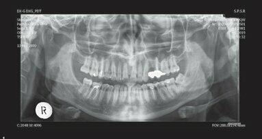 伴复杂根管系统的左侧上颌第一磨牙的 牙髓治疗