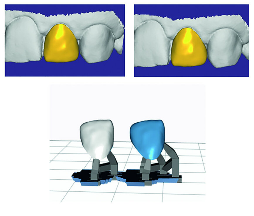 Fig. 16: With 3D printing, different shapes of the same tooth can be printed at the same time without additional time or cost.