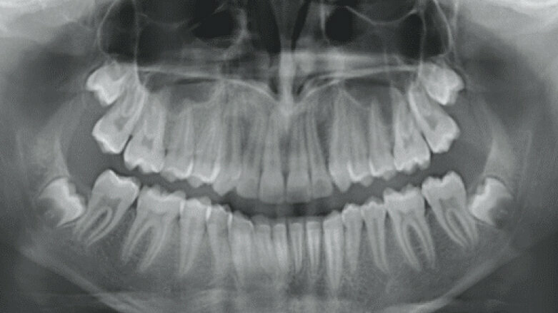 Treatment of Class II division 1 malocclusion treatment with mandibular advancement features
