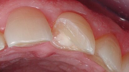 Figura 2. Protegiendo dentina con ionómero de vidro fotopolimerizable.