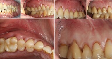 Tratamiento de sinusitis maxilar odontogénica mediante cirugía periapical