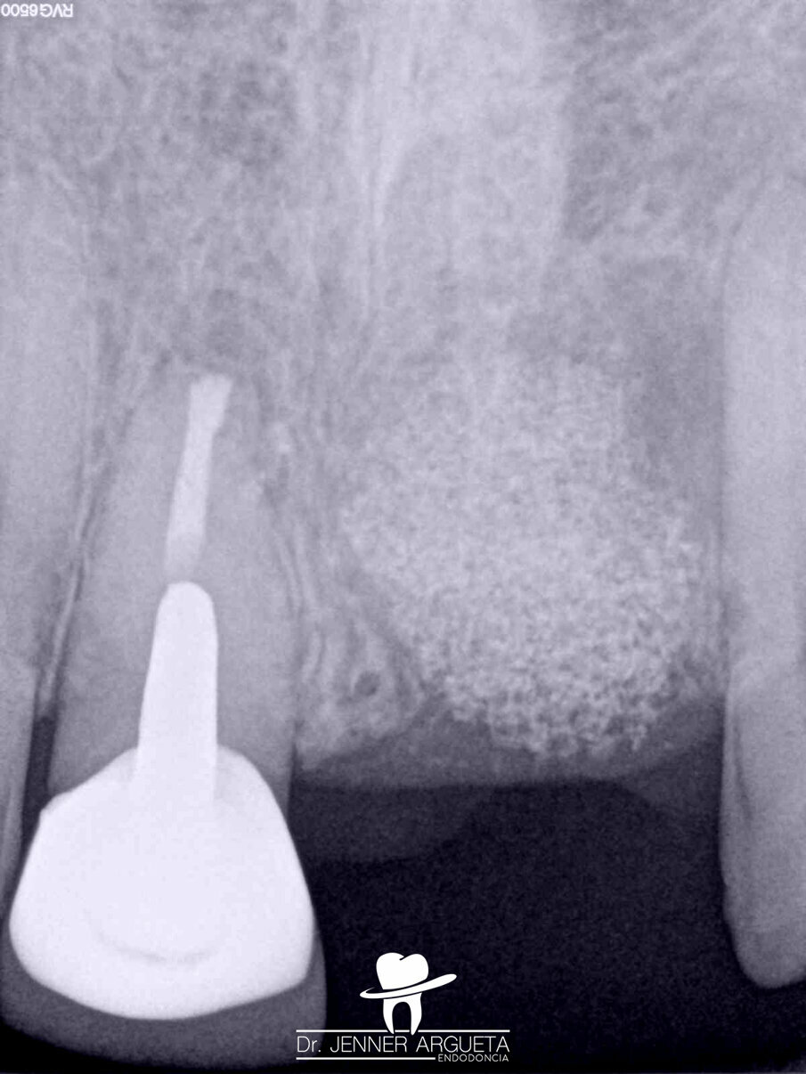 Fig. 15: Four-month follow-up radiograph showing the process of healing in both treated areas, the periapical surgery of tooth #11 and bone grafting at the extraction site of tooth #21.