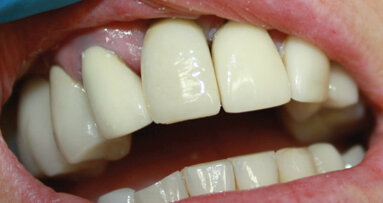 Case report: ‘unidentified dental implant’ restoration