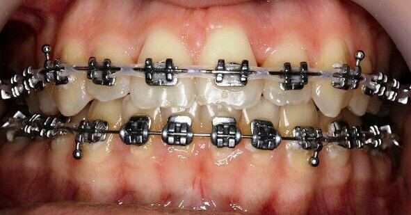 Obesity Influences Orthodontic Treatment in Adolescents - Dentistry Today  (DT)