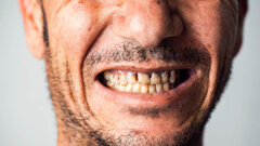 Cuộc khủng hoảng sức khỏe răng miệng của New Zealand diễn ra dữ dội