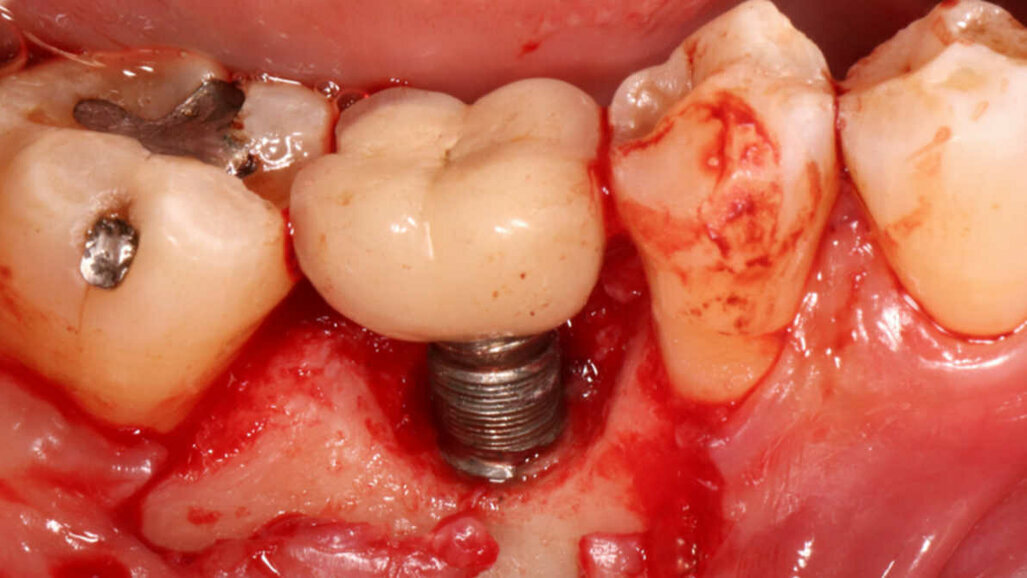 Estudo determina os motivos das técnicas de remoção e falha de implantes dentários
