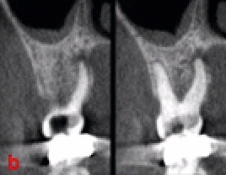 Fig. 47 : Deuxième molaire supérieure compromise (fissure et complication endodontique). 