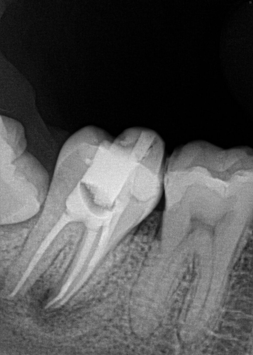 Fig. 15g: Cased treated with PIPs (photon-induced photoacoustic streaming). Note the orifice barrier placed in composite to protect the endodontic treatment from coronal leakage (courtesy of Dr. Paula Elmi).