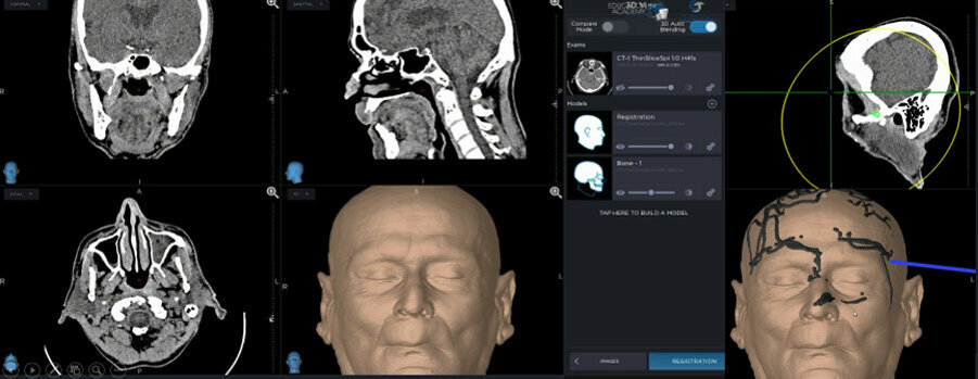 Fig. 4: StealthStation S8 matches the CT imaging with the patient’s actual anatomy.