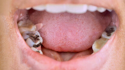 BDA Northern Ireland określa wycofywanie amalgamatu dentystycznego jako „niewykonalne”