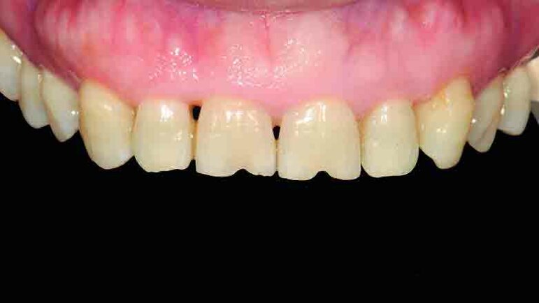 Dental News - Chairside CAD/CAM immediate restorations