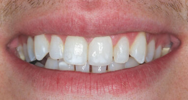 Central details: Smile renewed with esthetic Obsidian crown
