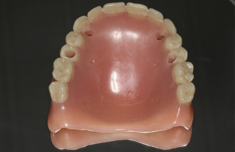 Fig. 4: The existing denture was adapted to be used as a surgical guide and provisional prosthesis for immediate loading.