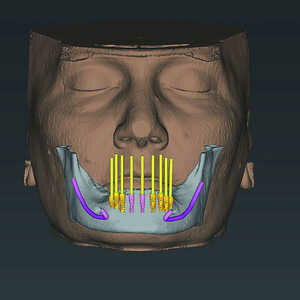 Fig-6-Analyse-dento-faciale-du-traitement-implantaire-proposé-dans-l’arcade-mandibulaire-300x300-
