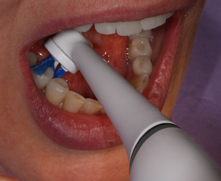 Fig. 4 - Testina Targeted Clean usata per pulire le aree linguali delle protesi supportate da impianti.