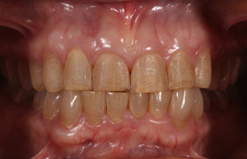 Fig. 18: Intra-oral photograph of conservative veneer preparations.