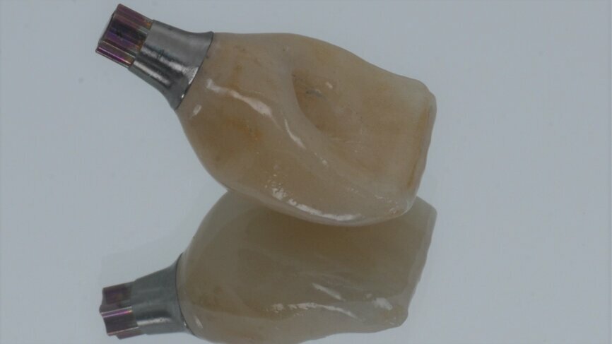 Fig. 30: Monolithic ceramic crown cemented to a regular base/wide base Variobase abutment.