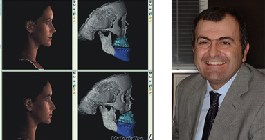 L’avvento della tecnologia tridimensionale nella Chirurgia Maxillo-Facciale: intervista ad Alberto Bianchi