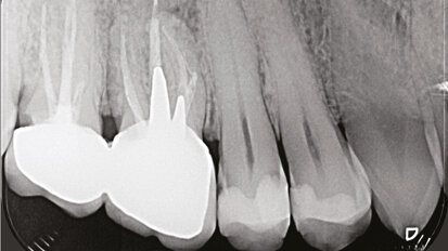 L’utilizzo della Cone Beam Computed Tomography (CBCT) in endodonzia clinica e chirurgica