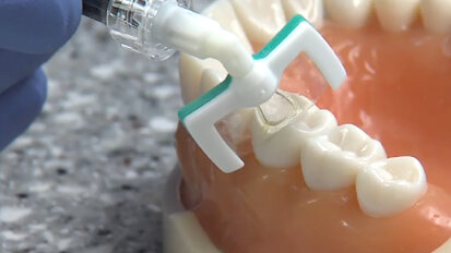 UAB - New cavity treatment offers no drilling, no filling