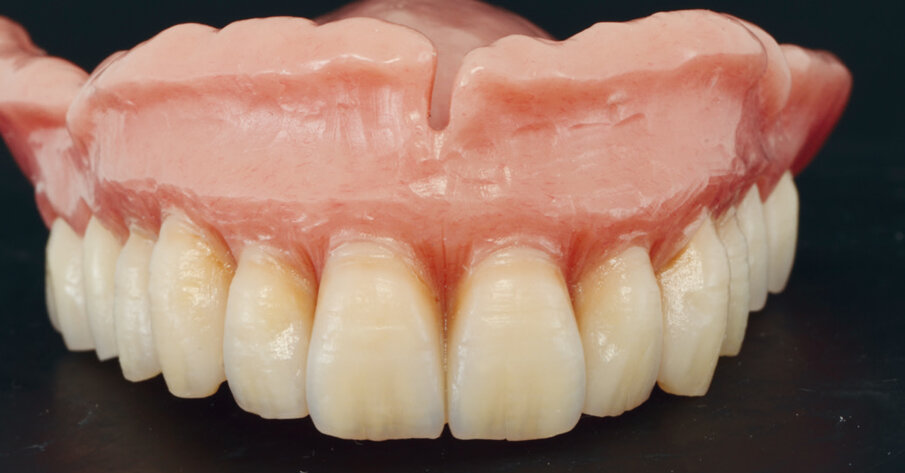 Fig: 6. The denture base was injection moulded and thenreduced to create space for creating soft tissue customisations.