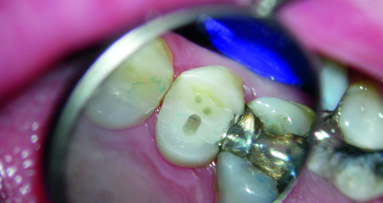 Fibre posts and tooth reinforcement: Evidence in the literature